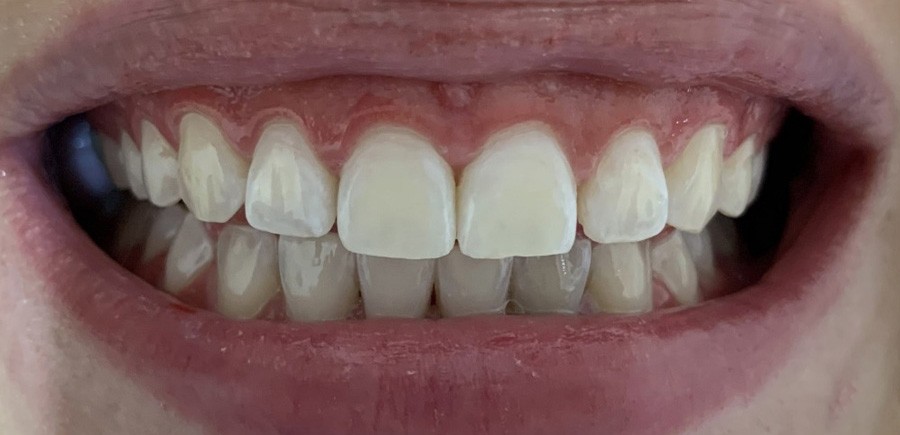 Before Whitening-Laser 2